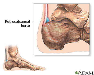 Retrocalcaneal bursitis Retrocalcaneal bursitis