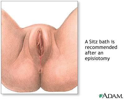 Episiotomy aftercare Episiotomy aftercare