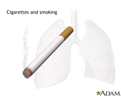 Smoking hazards Smoking hazards