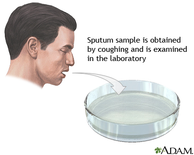 Sputum test Sputum test