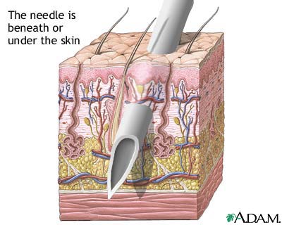 Skin layers and needles Skin layers and needles