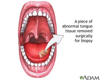Tongue biopsy Tongue biopsy