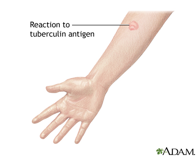 Tuberculin skin test Tuberculin skin test
