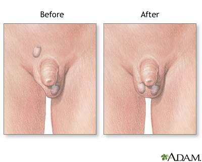 Before and after testicular repair Before and after testicular repair