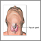 Thyroidectomy - Series Thyroidectomy - Series