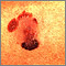 Skin cancer - malignant melanoma