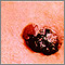 Skin cancer - raised multi-color melanoma