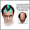 Male pattern baldness Male pattern baldness