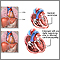 Alcoholic cardiomyopathy