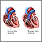 Tricuspid Regurgitation Tricuspid Regurgitation