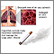 Smoking and COPD (chronic obstructive pulmonary disorder)