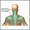 Location of whiplash pain Location of whiplash pain