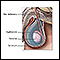 Hydrocele Hydrocele