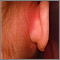 Mastoiditis - redness and swelling behind ear Mastoiditis - redness and swelling behind ear
