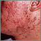 Acne - cystic on the face Acne - cystic on the face
