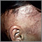 Alopecia, under treatment Alopecia, under treatment