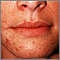 Perioral dermatitis