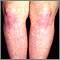 Dermatomyositis on the legs Dermatomyositis on the legs