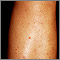Folliculitis on the leg Folliculitis on the leg