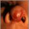 Hemangioma on the face (nose) Hemangioma on the face (nose)