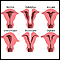 Congenital uterine anomalies Congenital uterine anomalies