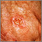 Skin cancer, squamous cell - close-up Skin cancer, squamous cell - close-up