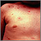 Urticaria pigmentosa on the chest Urticaria pigmentosa on the chest