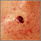 Skin cancer - close-up of level IV melanoma Skin cancer - close-up of level IV melanoma
