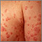 Psoriasis - guttate on the arms and chest