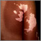 Vitiligo on the back and arm Vitiligo on the back and arm