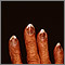 Cryoglobulinemia - fingers Cryoglobulinemia - fingers