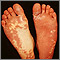 Sturge-Weber syndrome - soles of feet Sturge-Weber syndrome - soles of feet