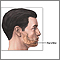 Chin augmentation - series