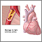 Coronary artery blockage Coronary artery blockage