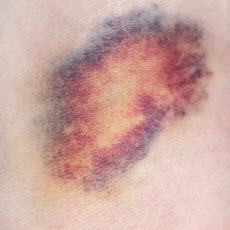 Bruises