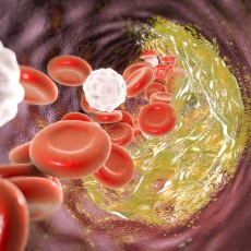 Coronary Artery Disease