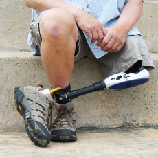 Limb Loss