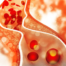 Peripheral Arterial Disease