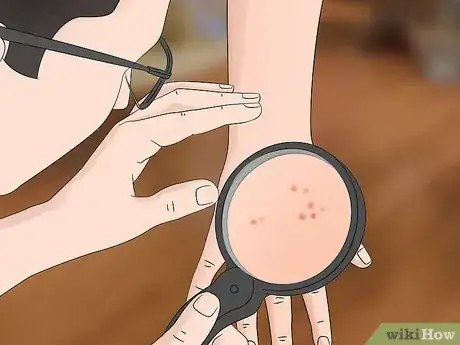 Image titled Treat Oak Mite Bites Step 6