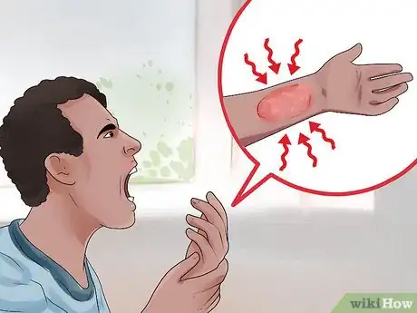 Image titled Tell the Difference Between Eczema and Psoriasis Step 6