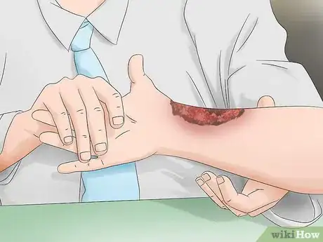 Image titled Heal Burns Fast Step 5