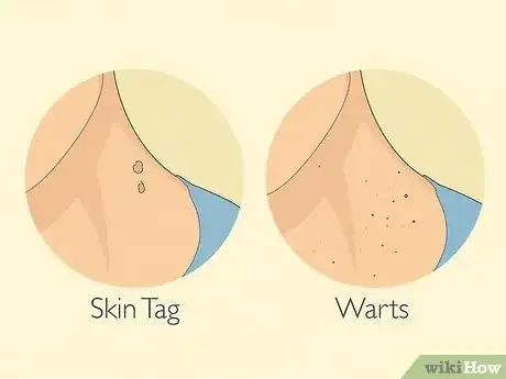 Image titled Get Rid of Skin Tags Step 1