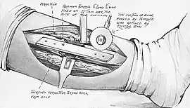 Image of a fractured tibia, shown in black and white but painted in watercolours, with an aluminium template nailed to the periosteum.