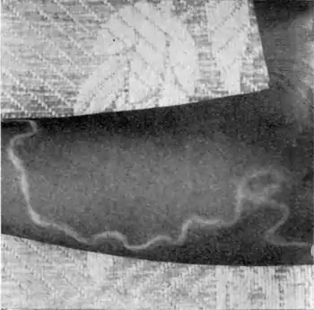 Tropical Diseases - Fig 149.png