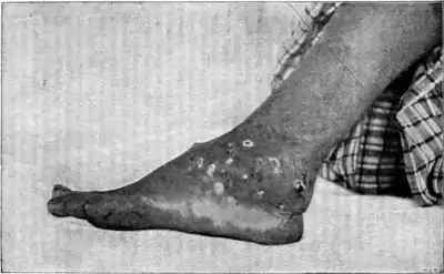 Tropical Diseases - Fig 205.png