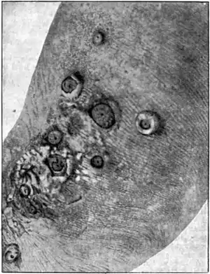 Tropical Diseases - Fig 210.png