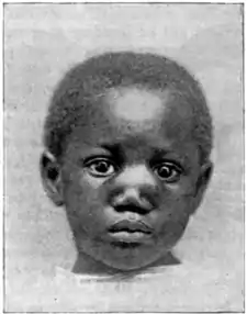 Tropical Diseases - Fig 223.png