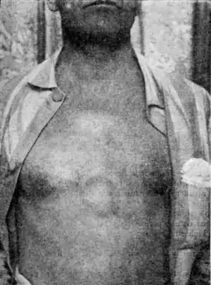 Tropical Diseases - Fig 48.png