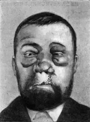 Tropical Diseases - Fig 60.png