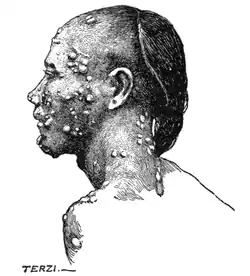 Tropical Diseases - Fig 89.png